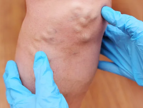 Varicose veins in the legs: When should you consult a vascular surgeon?
